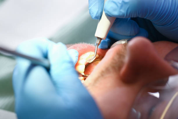 Best Emergency Dentist for Knocked-Out Tooth in Hamlet, IN